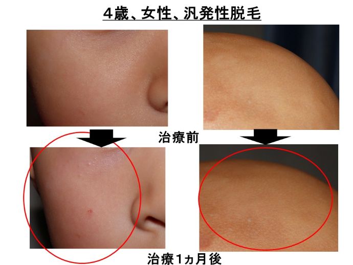 円形脱毛症　病院